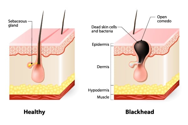 Best-skincare-routine-for-blackheads_1