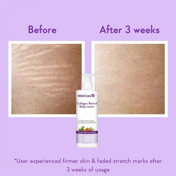 Before and After Results: Comparison images showing the effects of WishCare Collagen Retinol Body Lotion on skin firmness and reduction of stretch marks after 3 weeks of use.